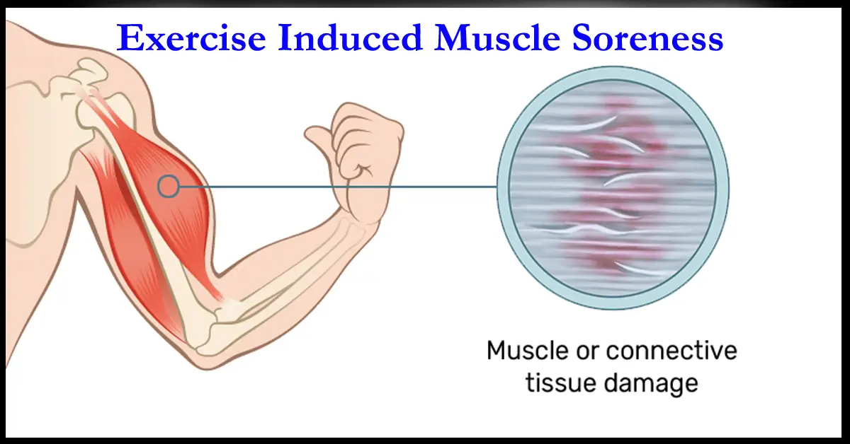 Exercise Induced Muscle Soreness